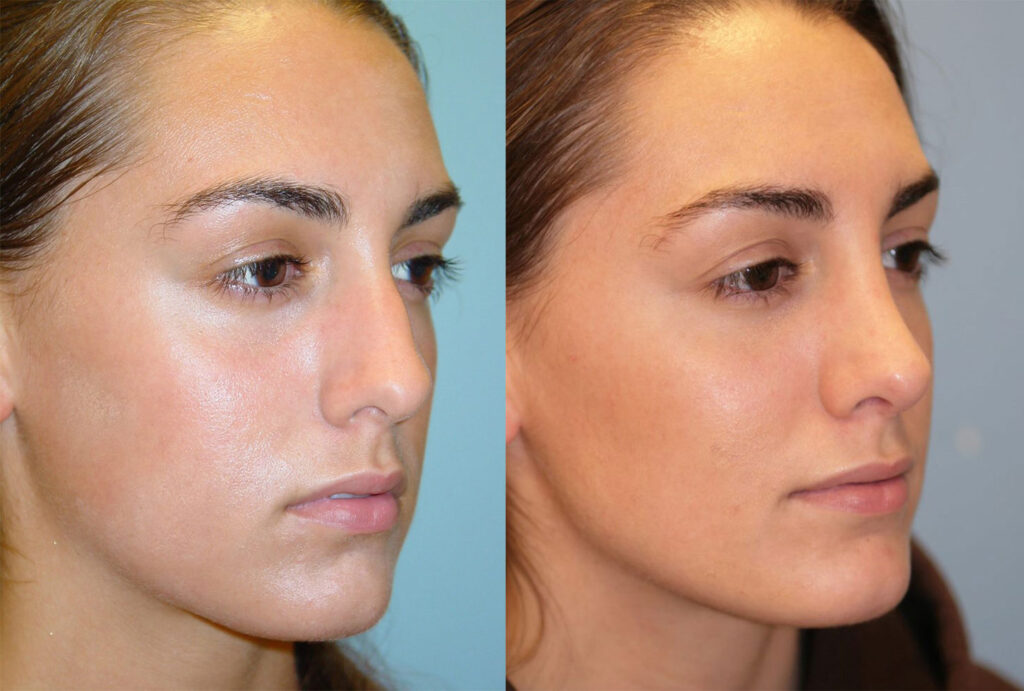 Rhinoplasty