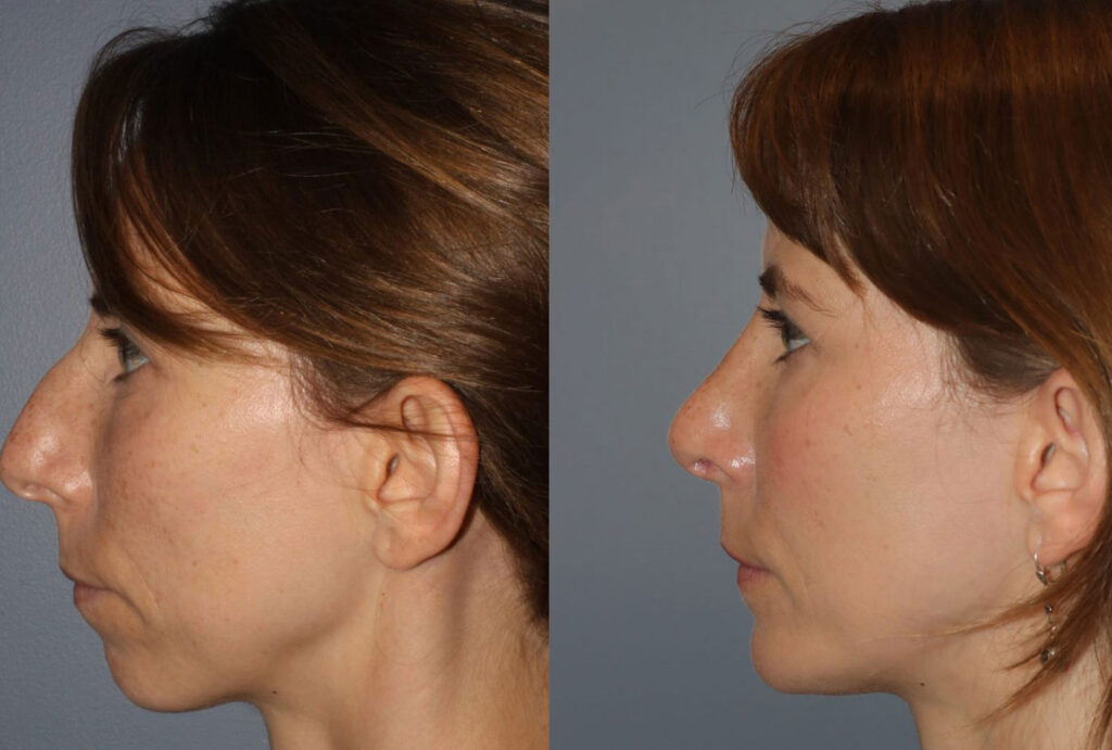 Rhinoplasty2