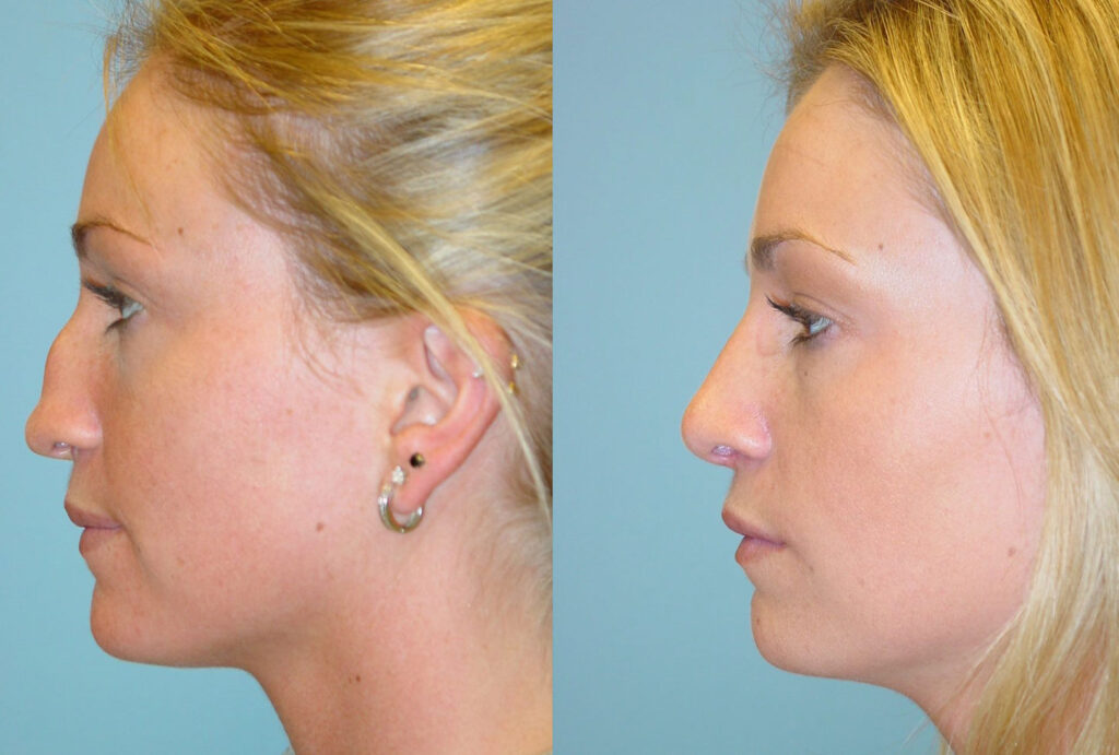 Rhinoplasty3
