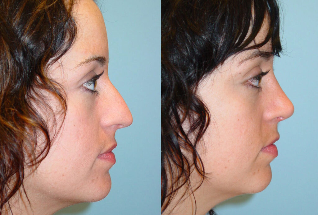 Rhinoplasty6