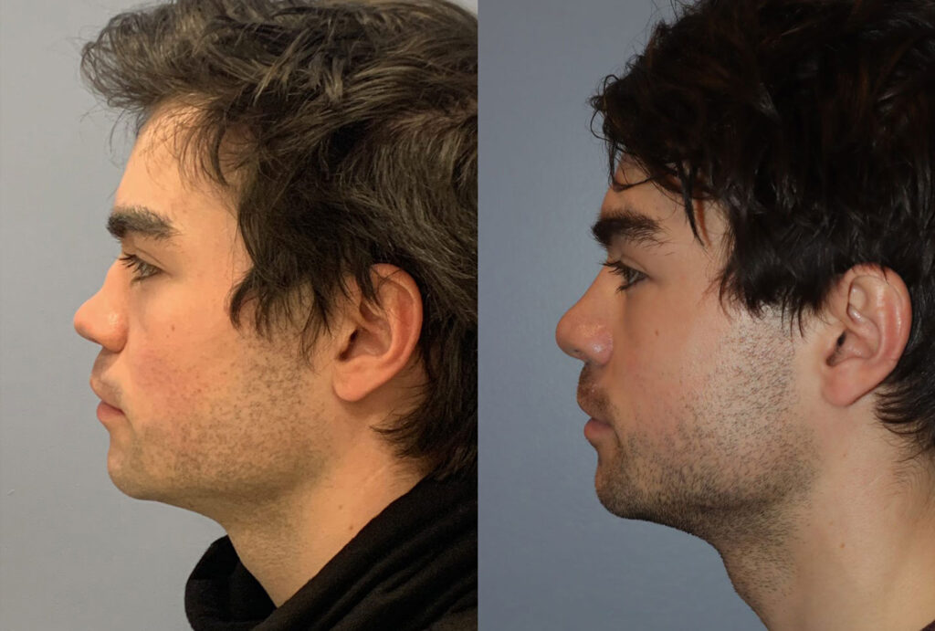 Rhinoplasty7