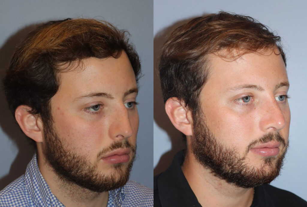 Rhinoplasty8